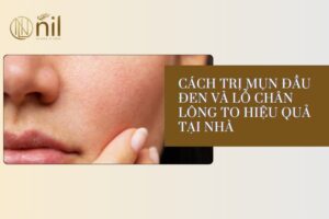 Cách trị mụn đầu đen và lỗ chân long to