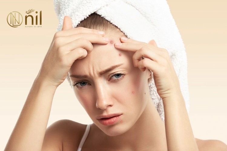 Cách trị thâm mụn nặng bằng sản phẩm đặc trị