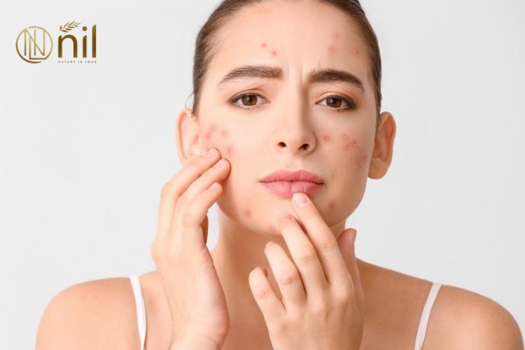 Gợi ý chu trình skincare buổi sáng cho da mụn