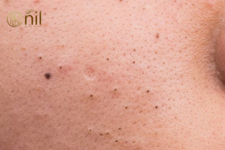 Mụn đầu đen và lỗ chân lông to – Nguyên nhân từ đâu?