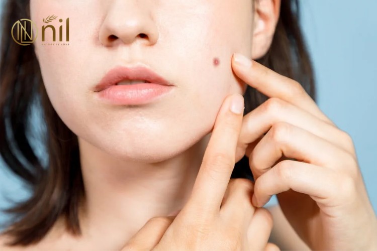 Tại sao thâm mụn nặng lại khó trị?