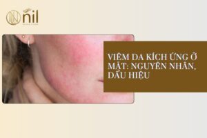 Viêm da kích ứng ở mặt