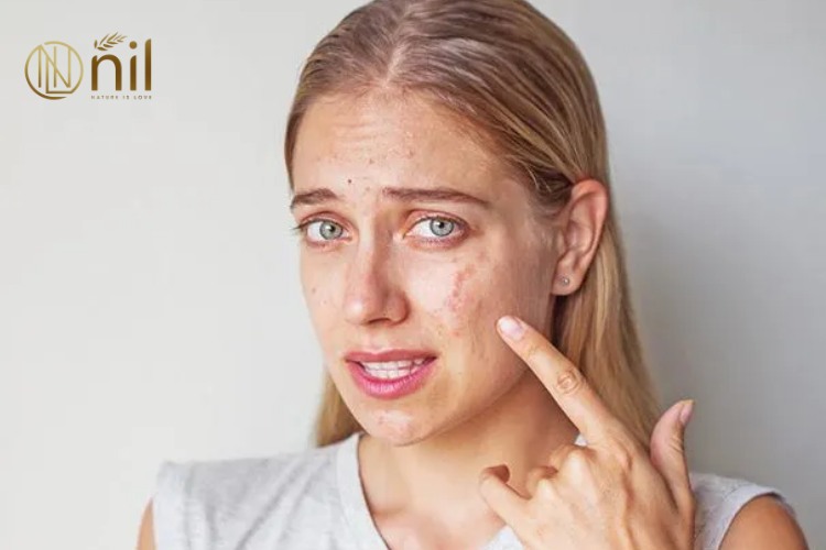 Dấu hiệu da bị kích ứng mỹ phẩm là gì?