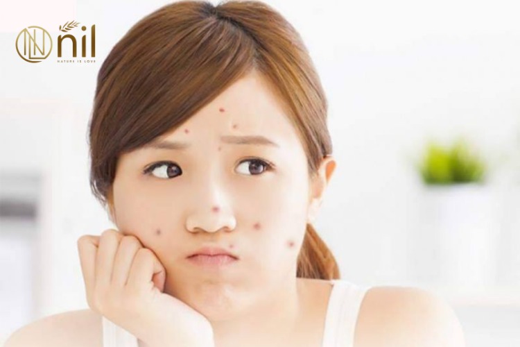 Tuổi 13 – Bắt đầu của những thay đổi lớn về làn da