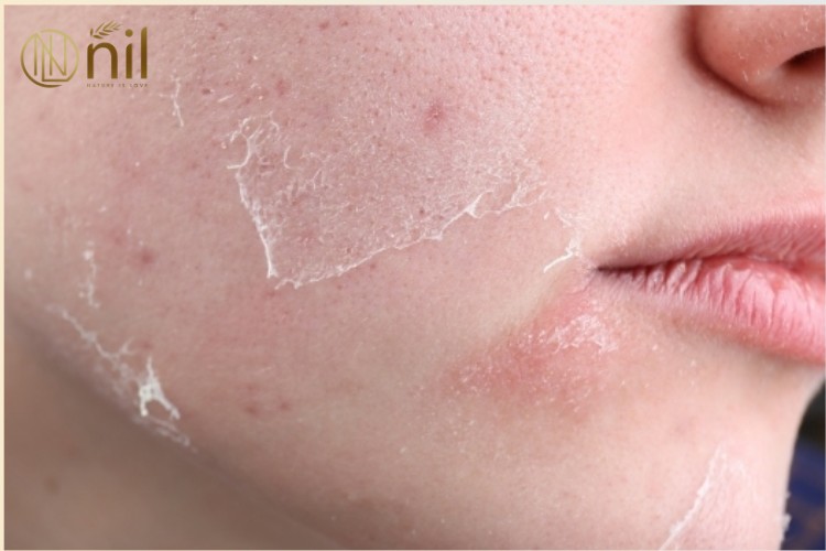 Tretinoin là gì và hoạt động như thế nào trên da?Tretinoin là gì và hoạt động như thế nào trên da?
