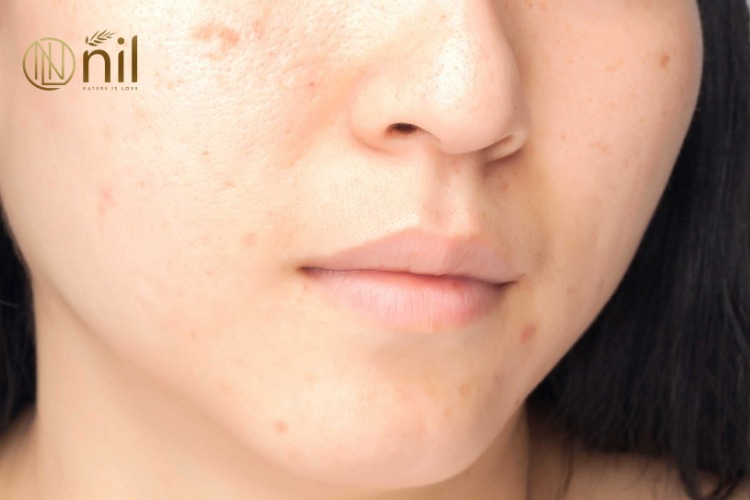 Nguyên nhân gây thâm mụn là gì?