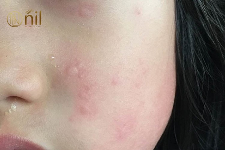 Viêm Da Kích Ứng Ở Mặt Là Gì?