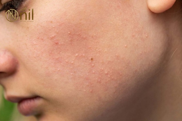 Cách phòng tránh dấu hiệu da bị kích ứng mỹ phẩm