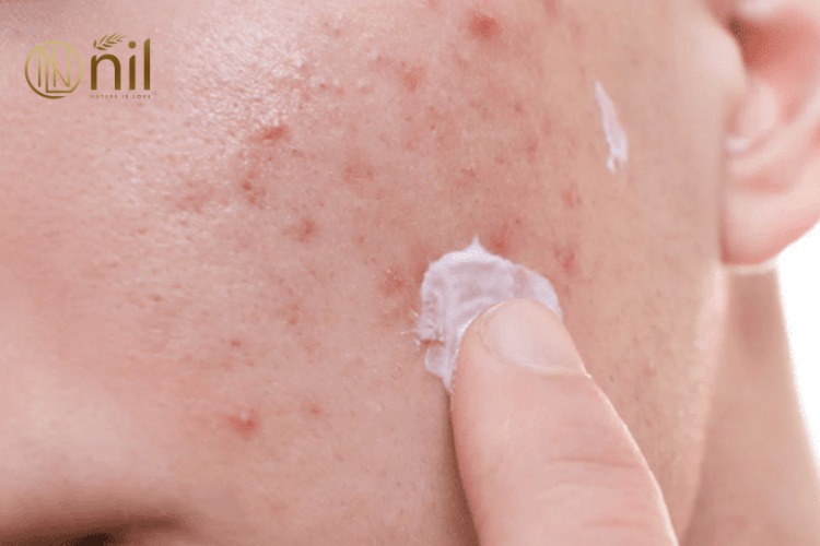 Cách trị thâm mụn hiệu quả tại nhà bằng nguyên liệu thiên nhiên