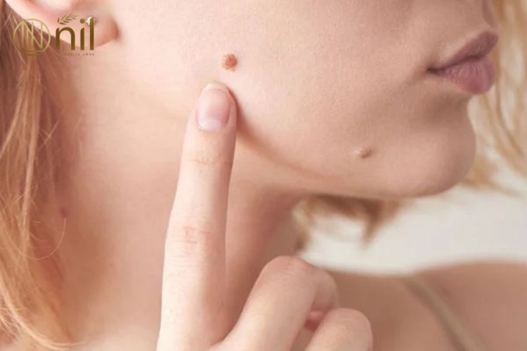 Mụn thịt là gì?
