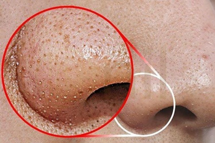 Mụn đầu đen ở mũi là gì?