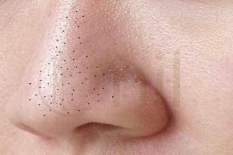 Có nên nặn mụn đầu đen ở mũi không?