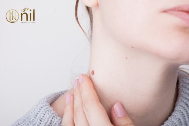 Các cách trị mụn thịt phổ biến hiện nay