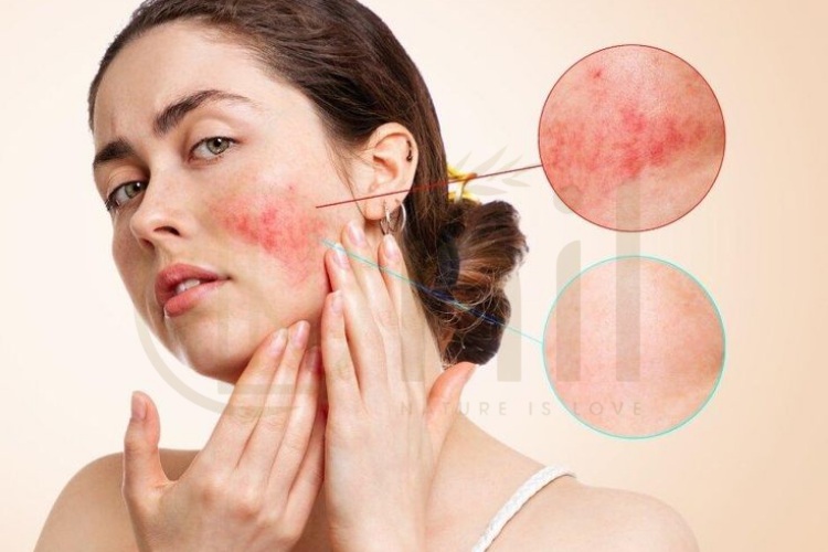 Da bị kích ứng là gì?