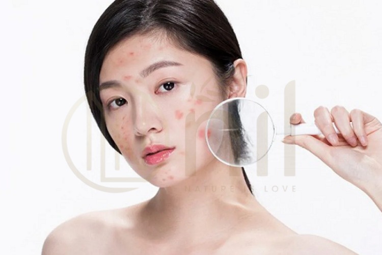 Điều trị mụn kích ứng bằng phương pháp y khoa