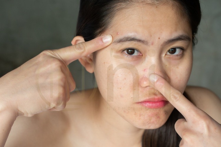 Mụn kích ứng là gì?
