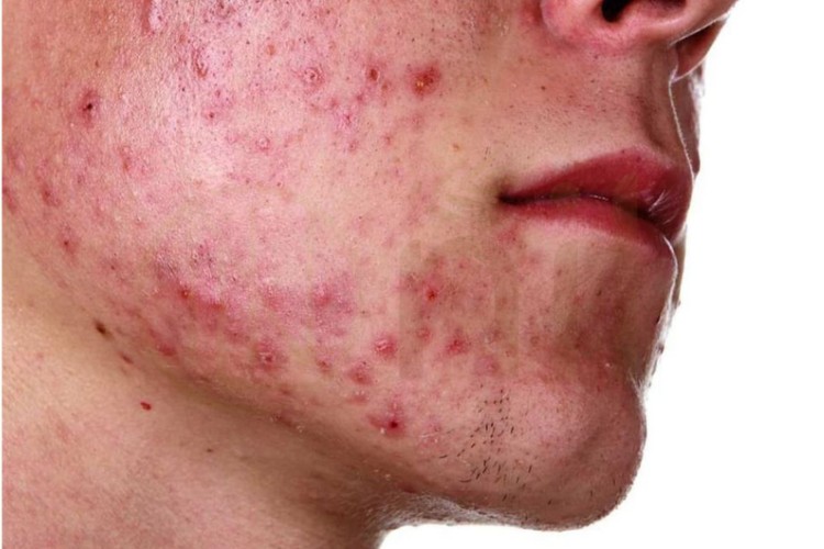Nguyên nhân gây ra vết thâm mụn trên mặt