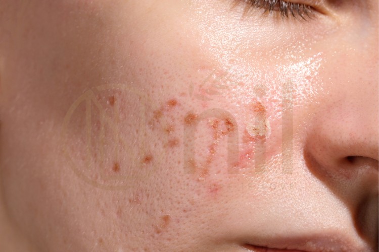 Hiểu rõ nguyên nhân gây kích ứng da