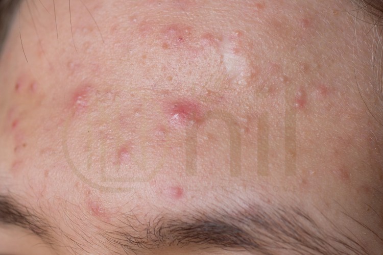 Phòng ngừa kích ứng da – Đừng để “mất bò mới lo làm chuồng”