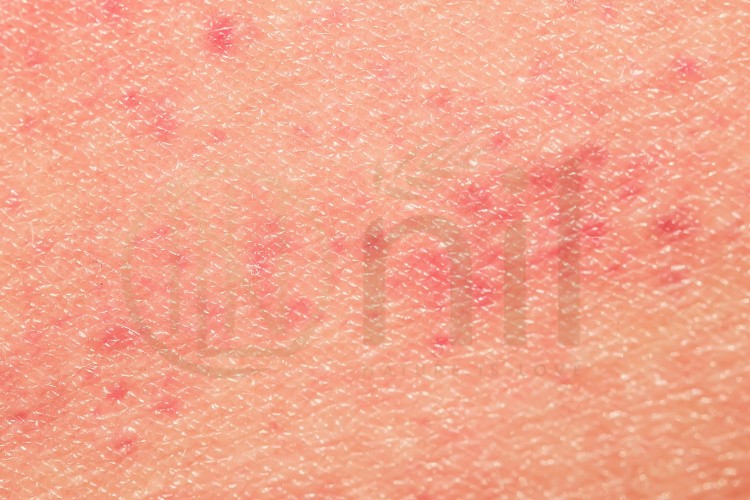Da bị kích ứng nên làm gì?