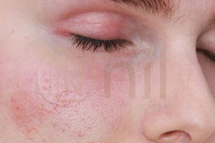 Nhận diện tình trạng da kích ứng