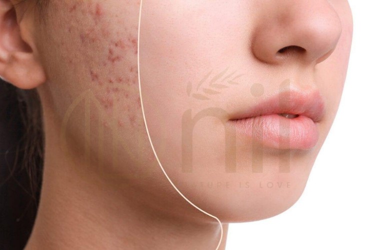 Các cách trị vết thâm mụn ở mặt tại nhà phổ biến