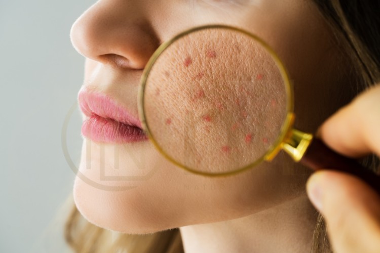 Làm gì khi da bị kích ứng? – 5 bước xử lý tại nhà