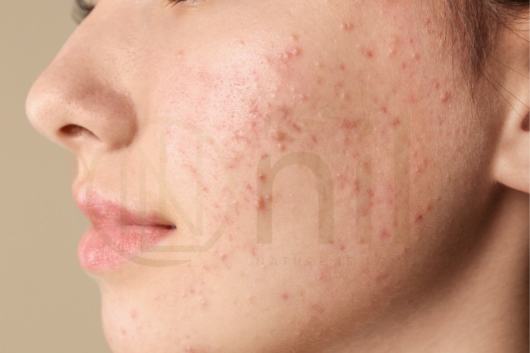 Nguyên nhân khiến da bị mụn thâm đỏ hai bên má