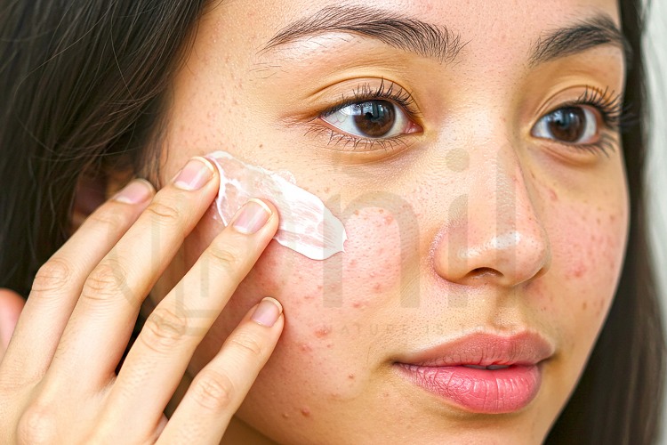 Kết hợp chăm sóc da đúng cách để trị mụn thâm đỏ hiệu quả hơn