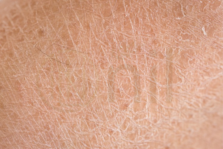 Da khô là gì? Vì sao cần lotion dưỡng ẩm body cho da khô?