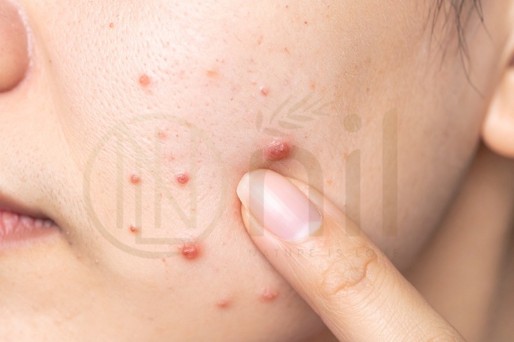 Kích ứng da là gì?