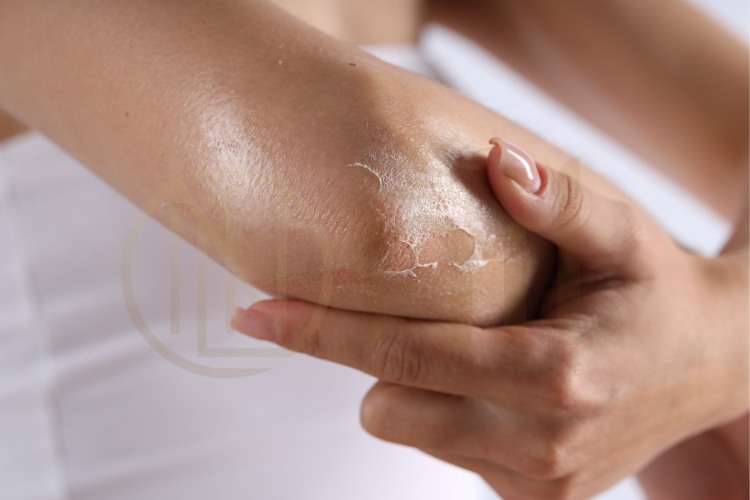 Nên dùng kem dưỡng ẩm body cho da khô khi nào?